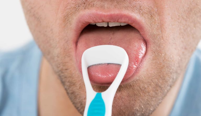 Các nguyên nhân dẫn đến hôi miệng (Halitosis)